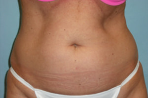 Liposuction