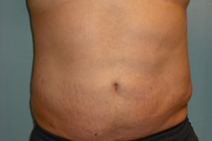 Liposuction