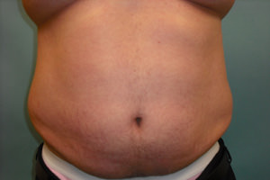 Liposuction