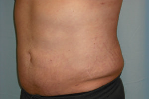 Liposuction