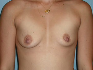 Breast Augmentation