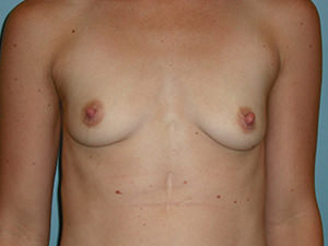 Breast Augmentation