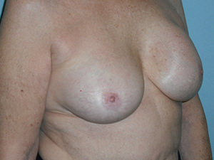 Breast Revision