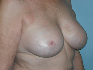 Breast Revision