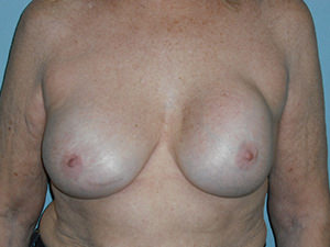 Breast Revision