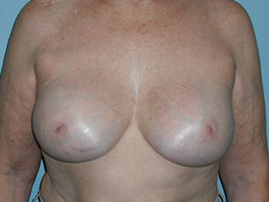 Breast Revision