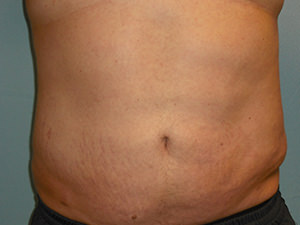 Liposuction