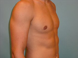 Male Breast Reduction - Gynecomastia