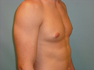 Male Breast Reduction - Gynecomastia