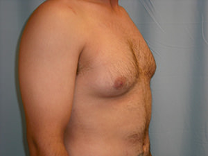 Male Breast Reduction - Gynecomastia