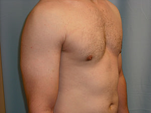 Male Breast Reduction - Gynecomastia