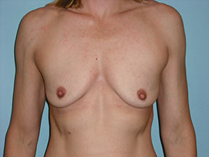 Breast Augmentation