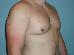 Male Breast Reduction - Gynecomastia