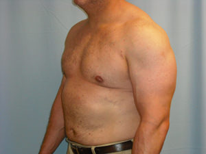 Male Breast Reduction - Gynecomastia