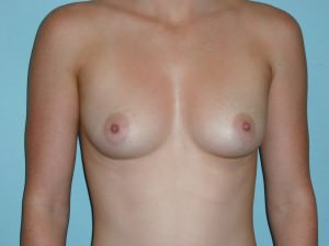 Breast Augmentation