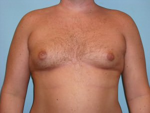 Male Breast Reduction - Gynecomastia