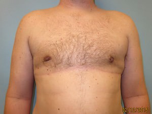 Male Breast Reduction - Gynecomastia