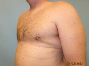 Male Breast Reduction - Gynecomastia