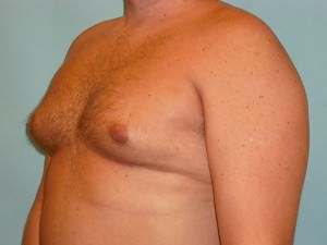 Male Breast Reduction - Gynecomastia