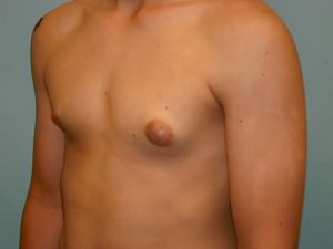 Male Breast Reduction - Gynecomastia