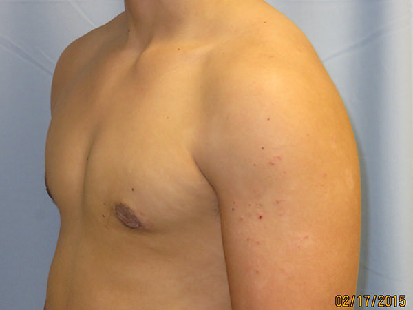 Male Breast Reduction - Gynecomastia