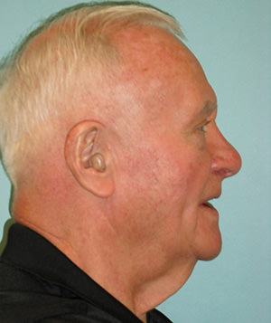 Neck Lift: Men