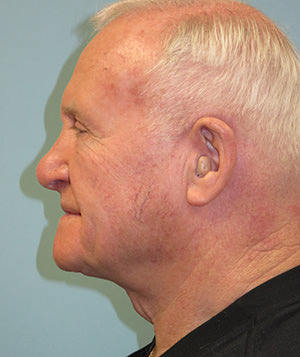 Neck Lift: Men