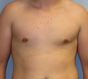 Male Breast Reduction - Gynecomastia