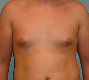 Male Breast Reduction - Gynecomastia