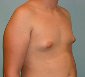 Male Breast Reduction - Gynecomastia