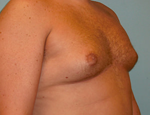 Male Breast Reduction - Gynecomastia