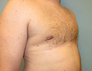 Male Breast Reduction - Gynecomastia