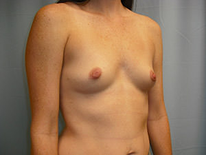 Breast Augmentation