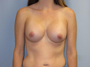 Breast Augmentation