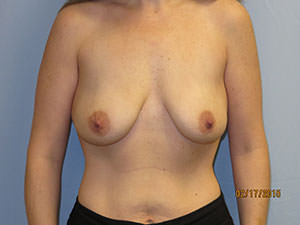 Breast Augmentation