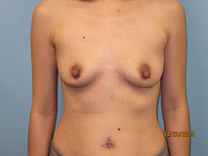 Breast Augmentation