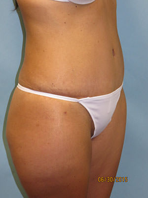 Tummy Tuck