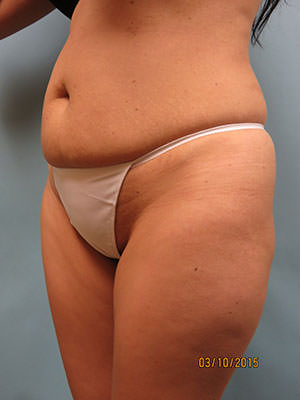 Tummy Tuck