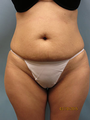 Tummy Tuck