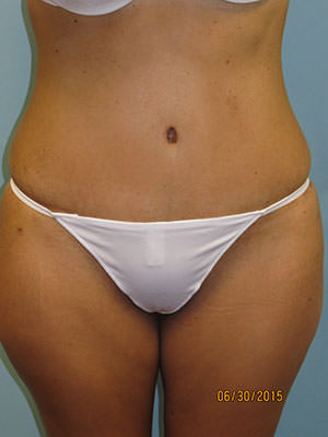 Tummy Tuck