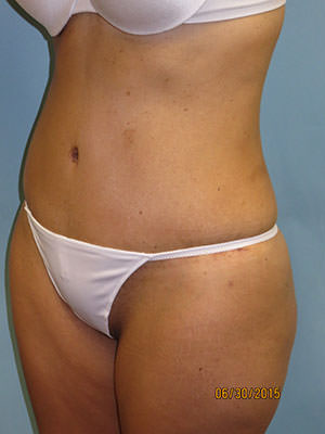 Tummy Tuck