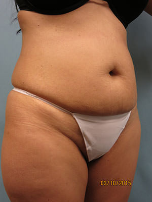 Tummy Tuck