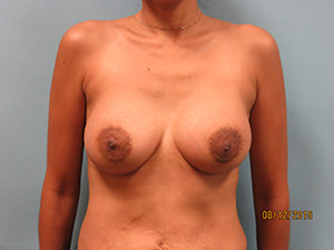 Breast Augmentation