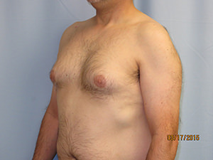 Male Breast Reduction - Gynecomastia