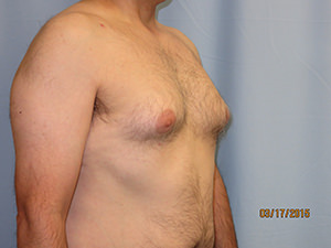 Male Breast Reduction - Gynecomastia