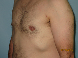 Male Breast Reduction - Gynecomastia