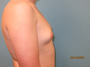 Male Breast Reduction - Gynecomastia