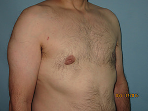 Male Breast Reduction - Gynecomastia