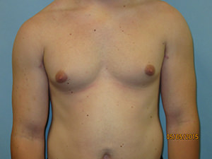 Male Breast Reduction - Gynecomastia