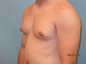 Male Breast Reduction - Gynecomastia